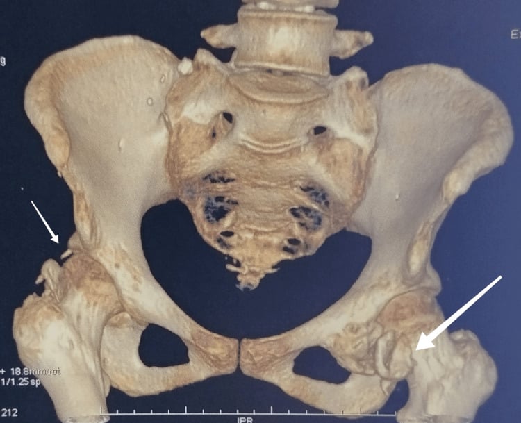 Three-dimensional reconstructed CT of the pelvis showing extensive bilateral heterotopic ossification