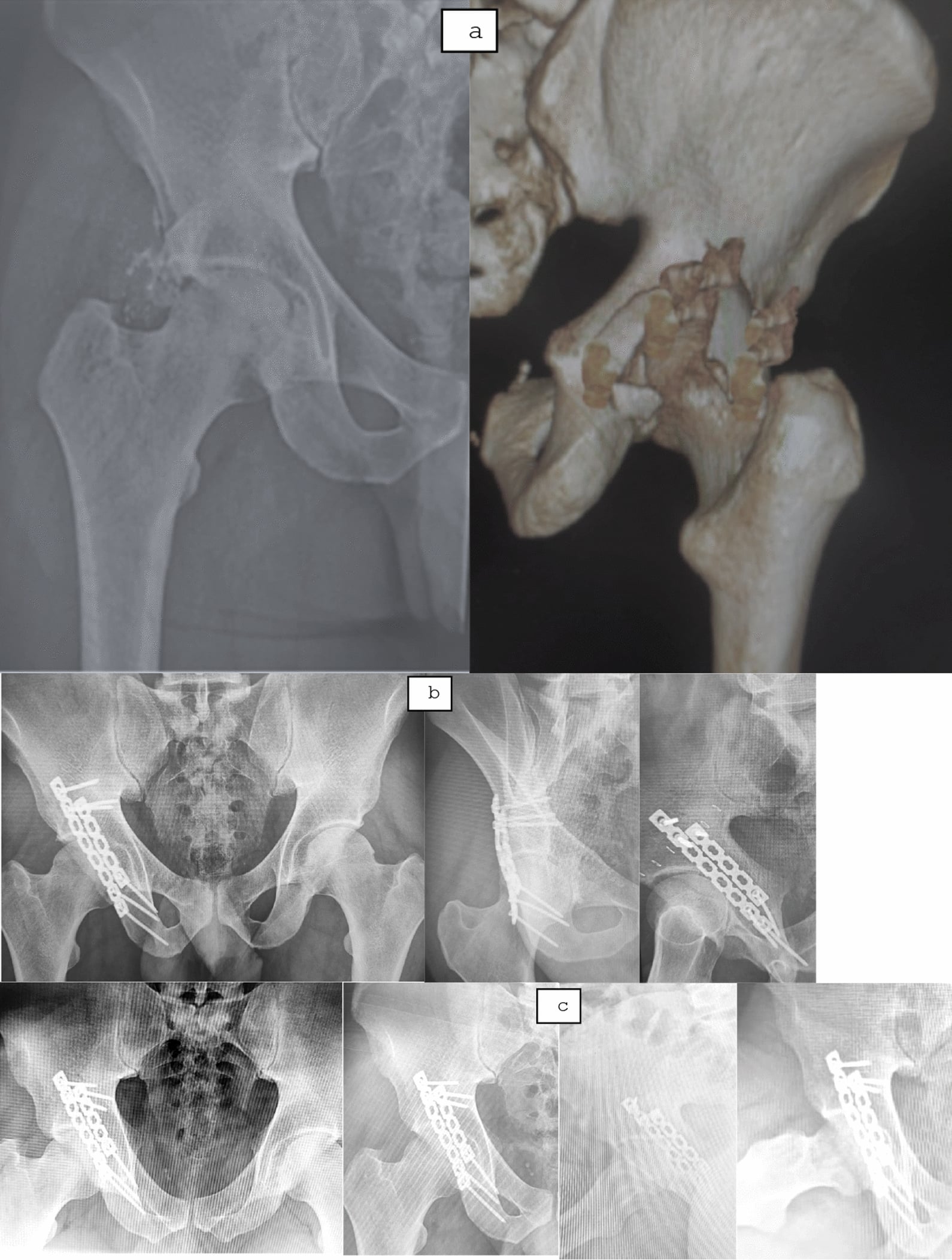 Preoperative radiograph and 3D CT of a comminuted posterior wall acetabular fracture