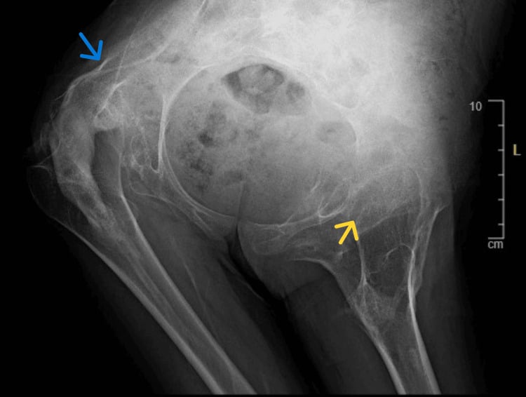 Pelvic radiograph showing periarticular ossification with a preserved hip joint space