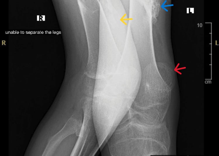 Knee radiograph showing ossified masses with cortical margins and internal trabeculation