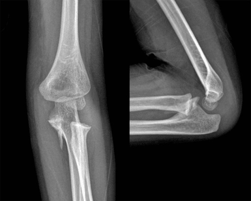 Elbow radiographs at six months showing calcification at the proximal ulna