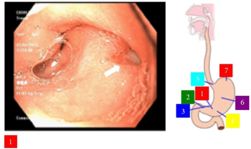 Endoscopic image of a penetrating ulcer in the gastric antrum