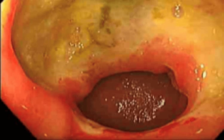 Endoscopic image of a large pyloric gastric ulcer