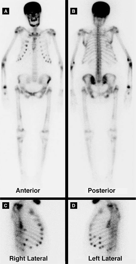 Four-panel Tc-99m MDP bone scintigram showing the superscan pattern