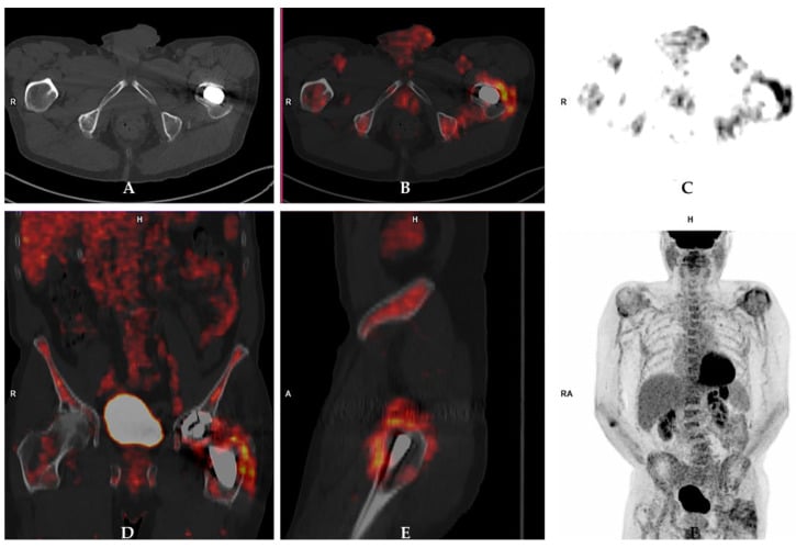 Axial, coronal and sagittal FDG PET-CT around a painful total hip arthroplasty