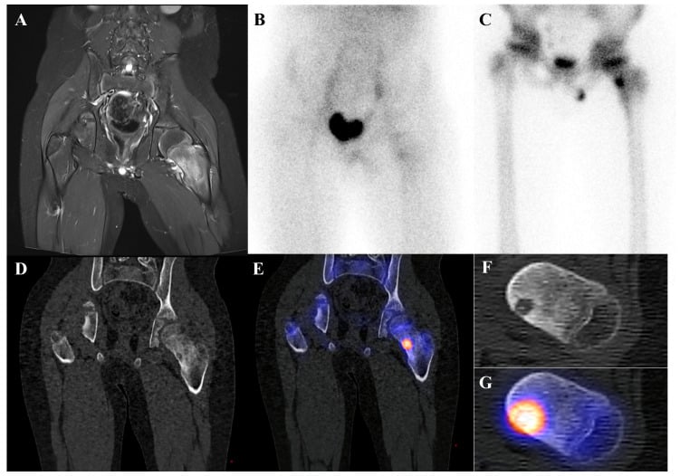 MRI, blood-pool and delayed bone scintigraphy with SPECT-CT of femoral-neck osteoid osteoma