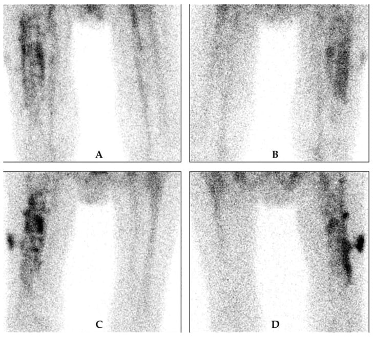 Delayed and late HMPAO-labelled white-cell scintigraphy in suspected prosthetic joint infection