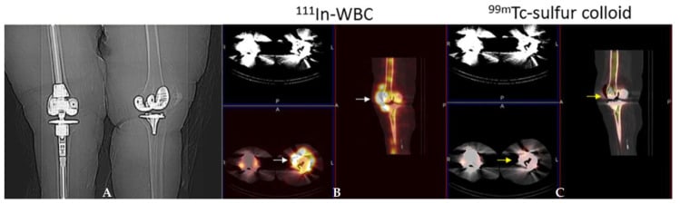 Radiograph, labelled white-cell SPECT-CT and marrow scintigraphy in knee arthroplasty infection