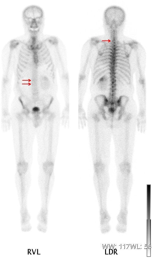 Whole-body anterior and posterior Tc-99m bone scan in renal cell carcinoma with bone metastases