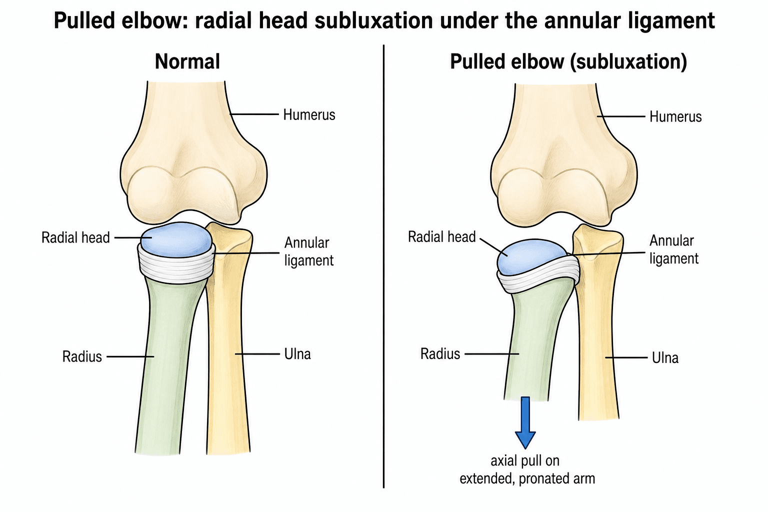 Two-panel diagram contrasting a normal elbow with a pulled elbow, where axial traction subluxes the radial head from under the annular ligament.