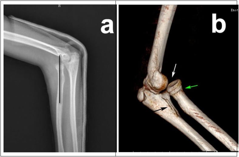 Lateral elbow radiograph with a line along the radial shaft missing the capitellum, showing anterior radial-head dislocation three weeks after injury.