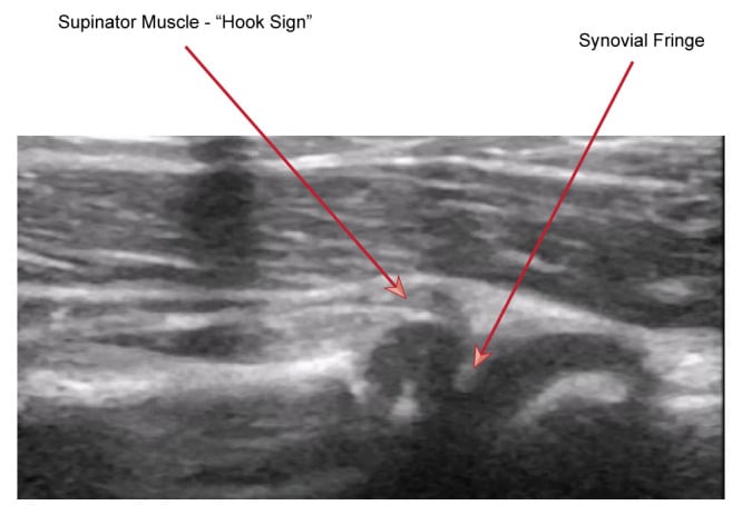 Point-of-care ultrasound of a pulled elbow showing a J-shaped hypoechoic band of interposed annular ligament and supinator.