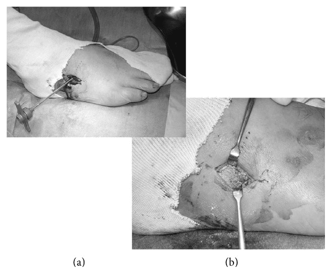 Operative images showing cuboid bone void filling after disimpaction