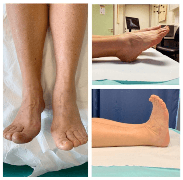 Clinical photographs at follow-up after fixation of combined navicular and cuboid fractures, showing both feet from the front and the foot in plantarflexion and dorsiflexion