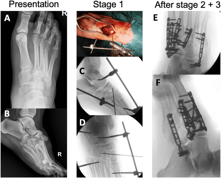 Presentation radiographs, stage 1 operative photograph and fluoroscopy with an external fixator, and plate fixation after stages 2 and 3, in a staged combined Chopart and Lisfranc injury