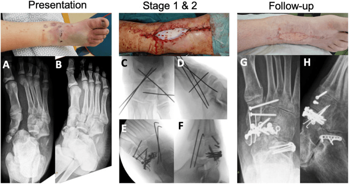 Second staged combined Chopart Lisfranc injury: presentation photograph and radiographs, stage 1 and 2 wound and fluoroscopy, and follow-up photograph and radiographs