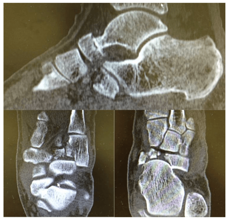 Multiplanar foot CT showing combined navicular and cuboid fractures