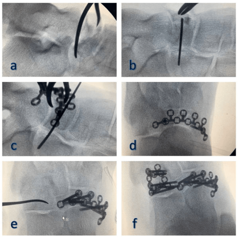 Intraoperative fluoroscopy of reduction and plate fixation of combined navicular and cuboid fractures