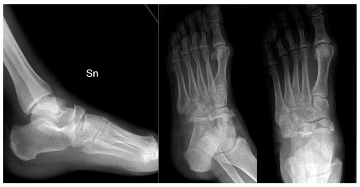 Preoperative foot radiographs of combined navicular and cuboid fractures