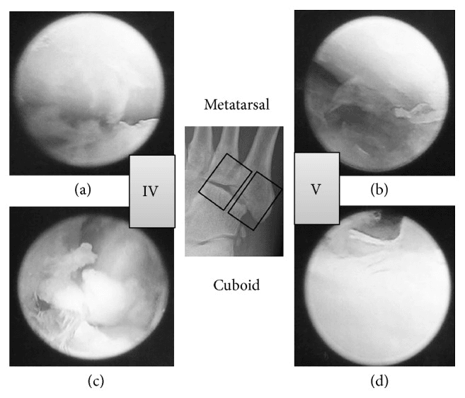 Arthroscopic views of cuboid fourth and fifth tarsometatarsal articular surfaces