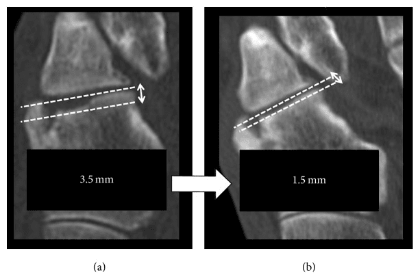 CT images measuring cuboid articular depression at 3.5 mm before and 1.5 mm after reduction