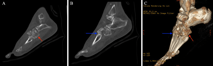 Sagittal and 3D CT showing comminuted cuboid fracture and third tarsometatarsal dislocation