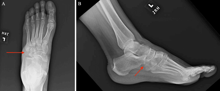 AP (A) and lateral (B) radiographs of a left foot with red arrows marking a cuboid fracture