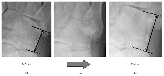 Serial foot radiographs measuring lateral-column restoration from 24.5 mm to 29.6 mm