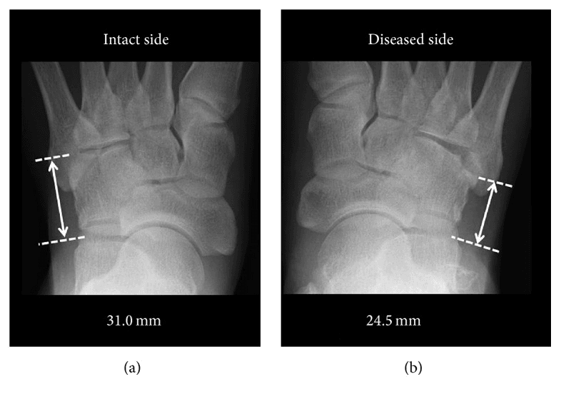 Comparative foot radiographs measuring the lateral column at 31.0 mm on the intact side and 24.5 mm on the injured side