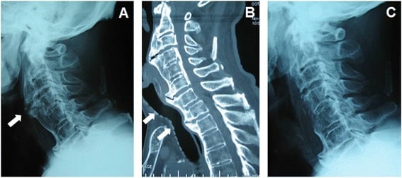 Preoperative radiograph and sagittal CT with postoperative radiograph after cervical osteophytectomy