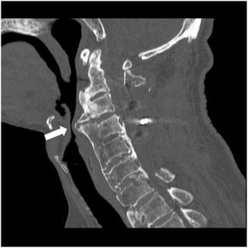 Sagittal CT showing cervical anterior osteophytes overhanging the posterior hypopharyngeal wall