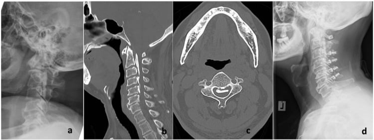 Cervical OPLL on lateral radiograph, sagittal CT and axial CT, with a postoperative lateral radiograph showing laminoplasty implants