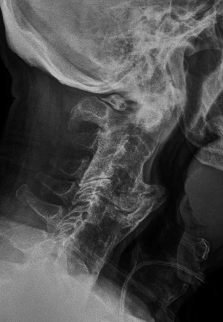 Lateral cervical radiograph showing bulky anterior osteophytes effacing the hypopharyngeal airway contour