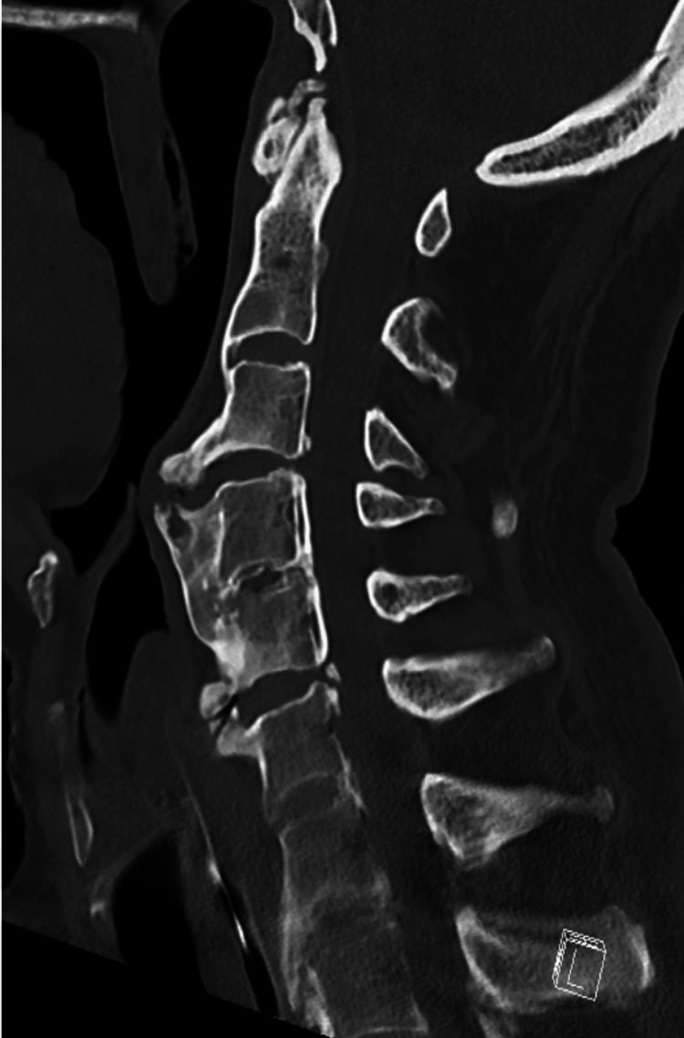 Sagittal CT showing a thick anterior ossified mass in cervical OALL and its relationship to the pharynx