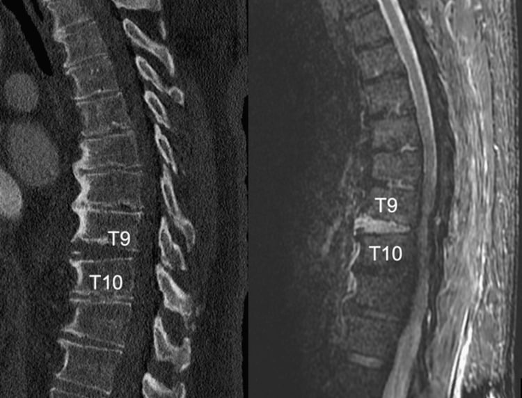 Sagittal CT and MRI of a T9βT10 fracture through a DISH-ankylosed thoracic spine, with high MRI signal at the T9βT10 level