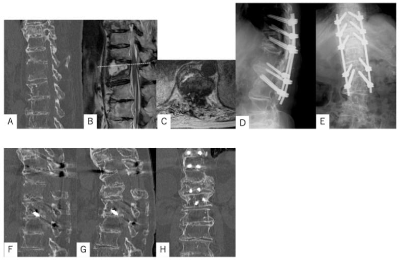 CT MRI and long-segment fixation of a distracted thoracolumbar fracture in DISH