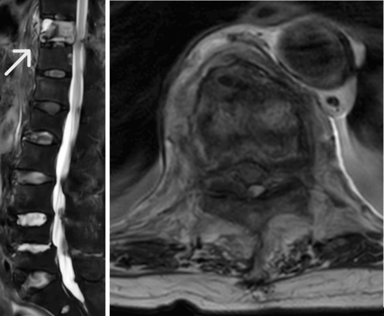 Sagittal STIR and axial T2 MRI showing an acute thoracic fracture in DISH