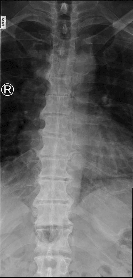 AP thoracic spine radiograph showing the flowing, rippled 'melted candle wax' ossification of DISH with right-sided predominance