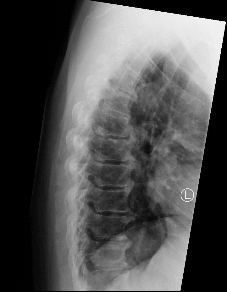 Lateral thoracic spine radiograph showing confluent flowing anterior ossification bridging multiple contiguous vertebral bodies in DISH