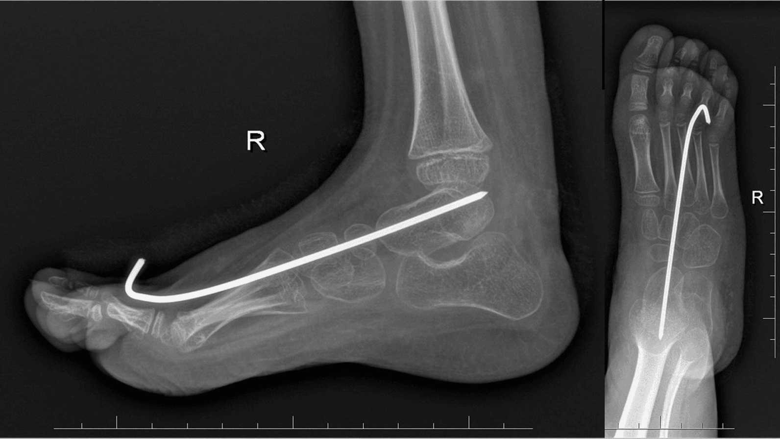 Anteroposterior and lateral radiographs after talonavicular reduction and K-wire fixation for congenital vertical talus