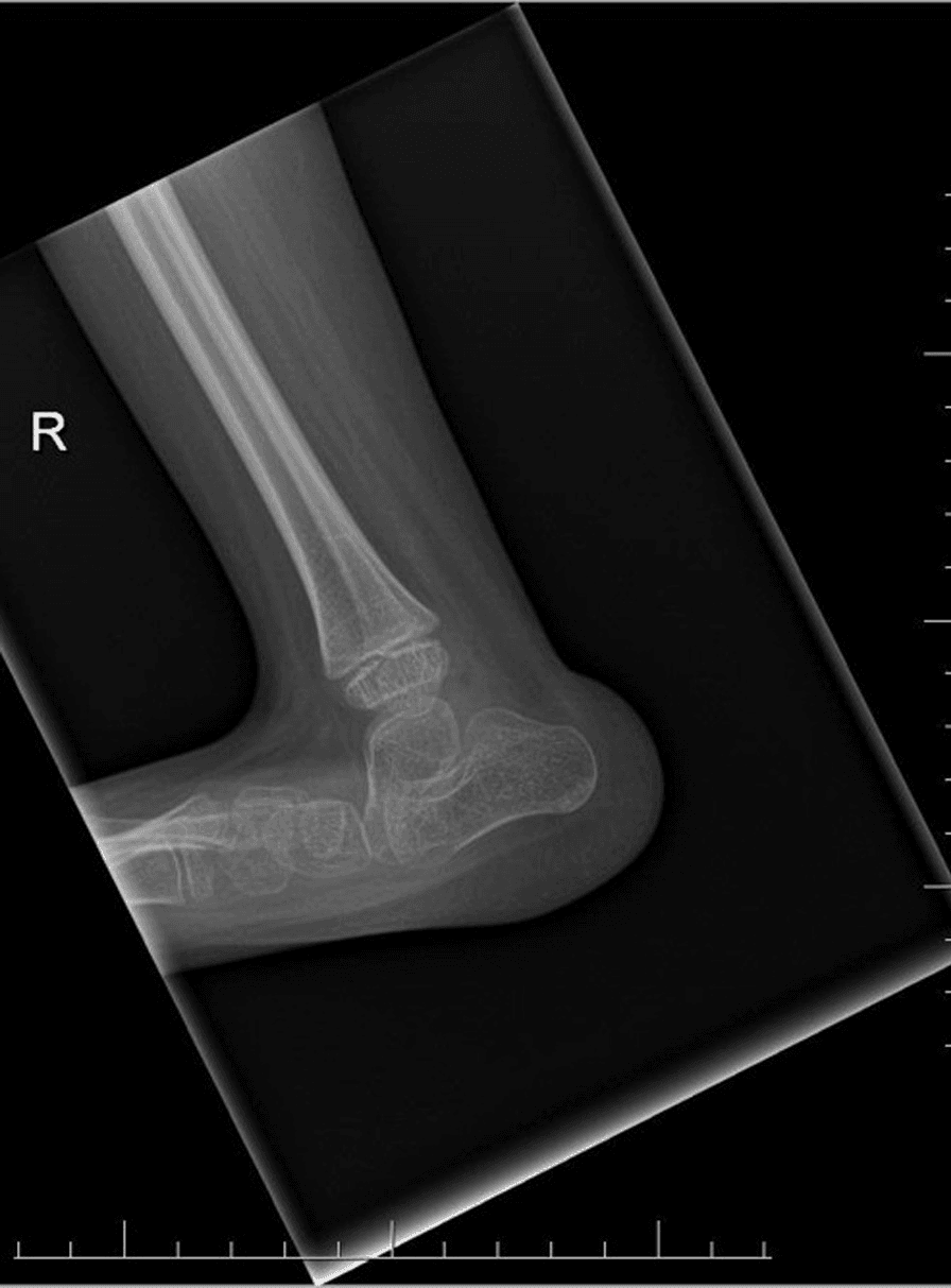 Pre-treatment lateral radiograph of congenital vertical talus, marked R