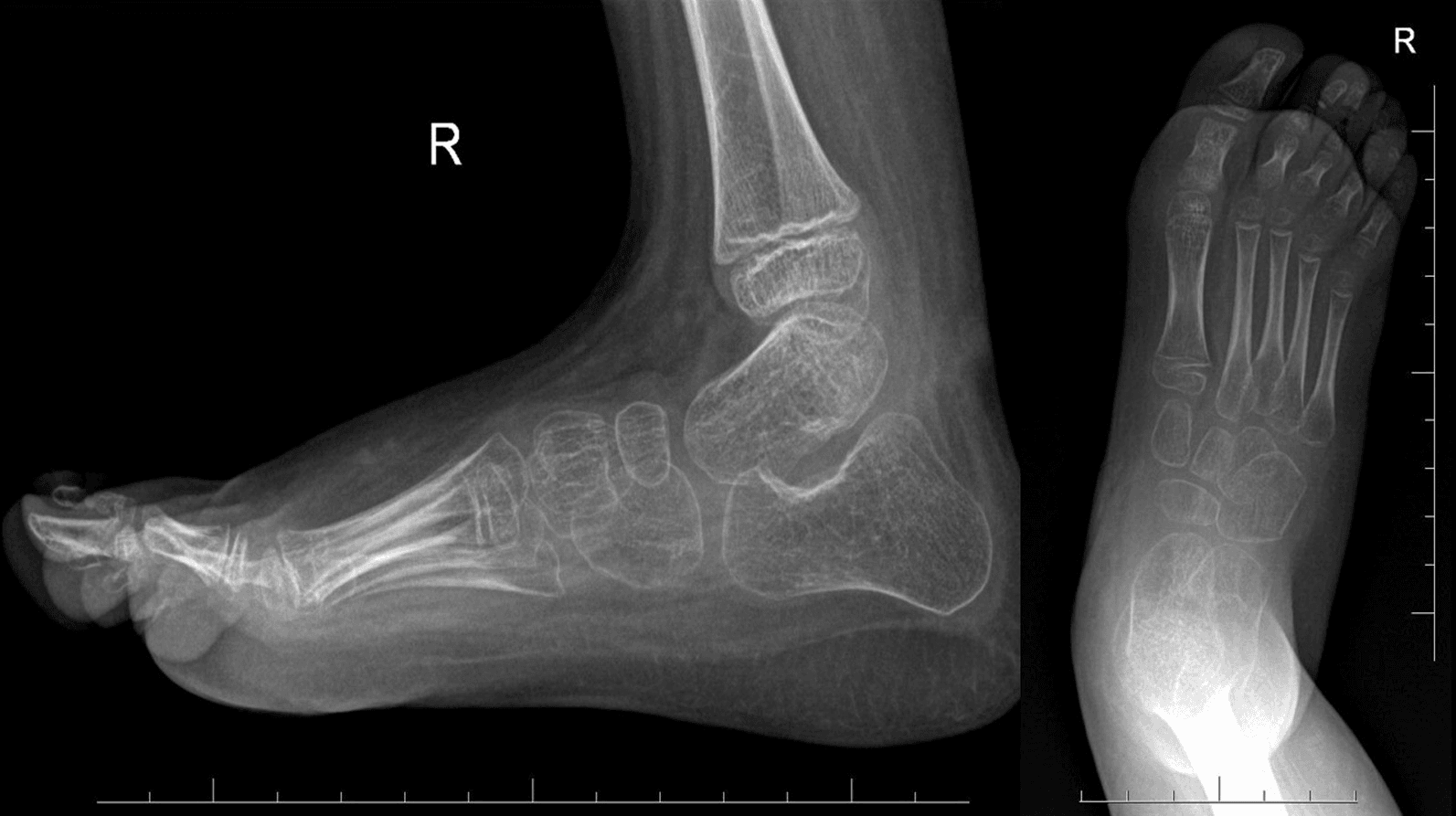 Final follow-up anteroposterior and lateral radiographs after congenital vertical talus treatment