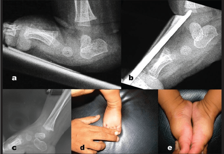 Congenital vertical talus: resting, plantarflexion-stress and follow-up lateral radiographs (a-c) with clinical photographs of the feet (d, e)