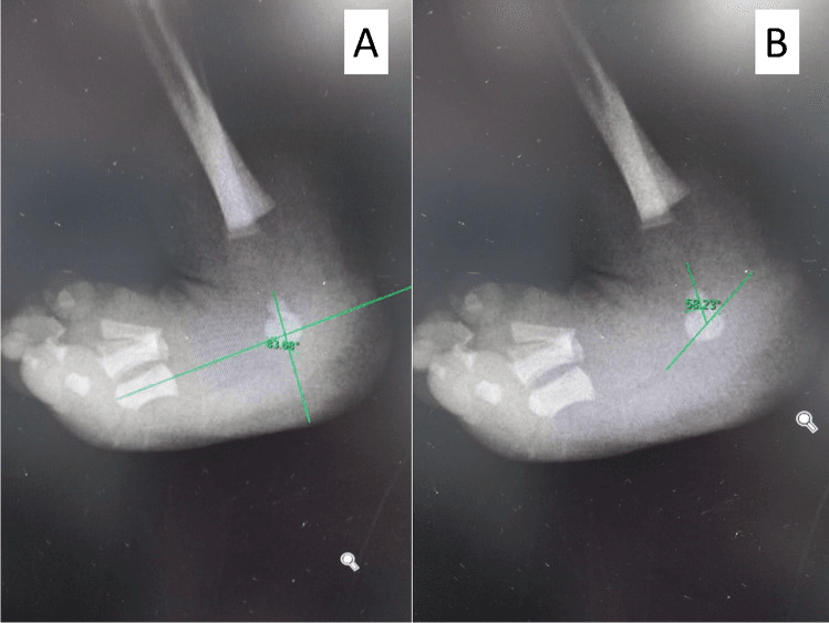 Two lateral infant foot radiographs, panels A and B, with TAMBA and talocalcaneal angle measurement lines