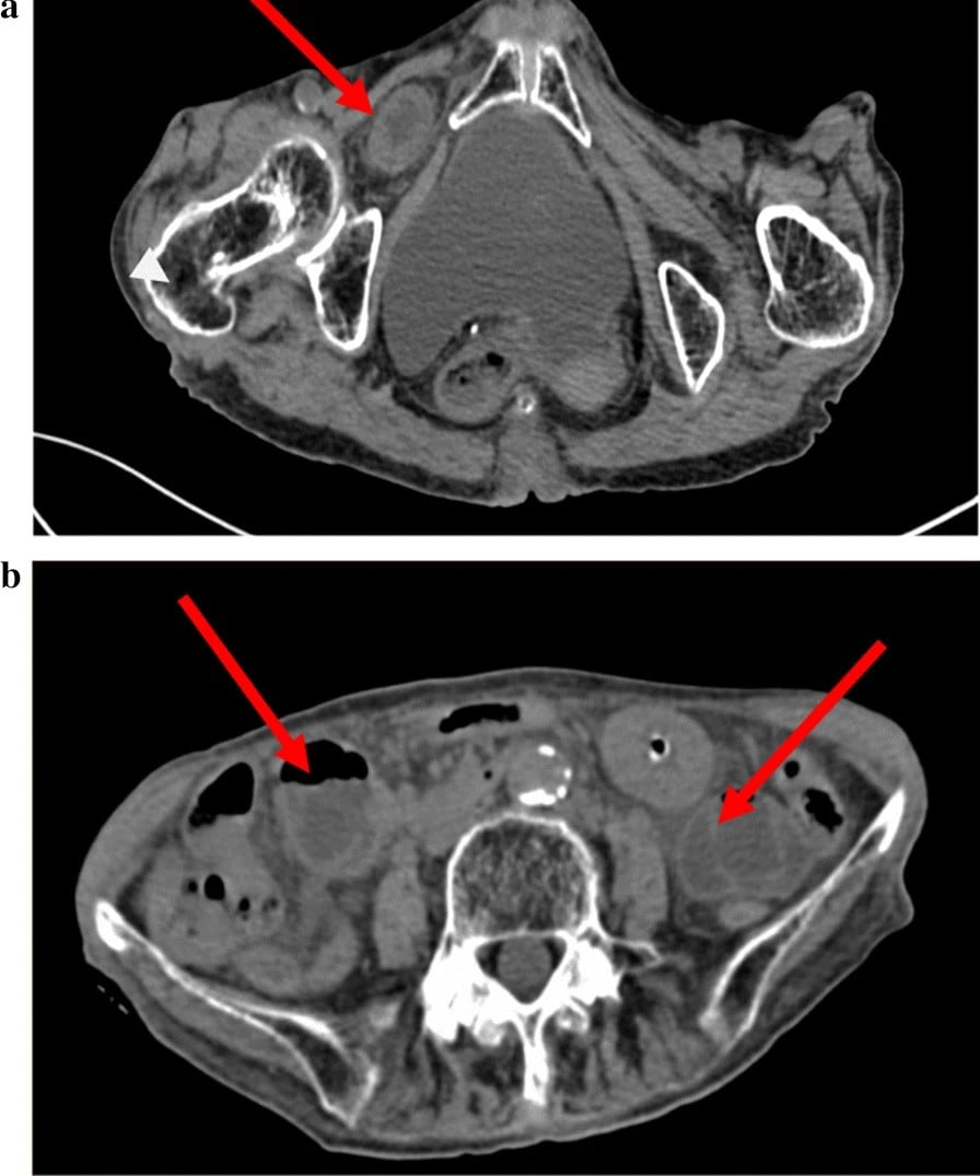 Two axial pelvic CT panels showing an obturator hernia: a loop of bowel herniating through the obturator canal between pectineus and obturator externus, arrowed.