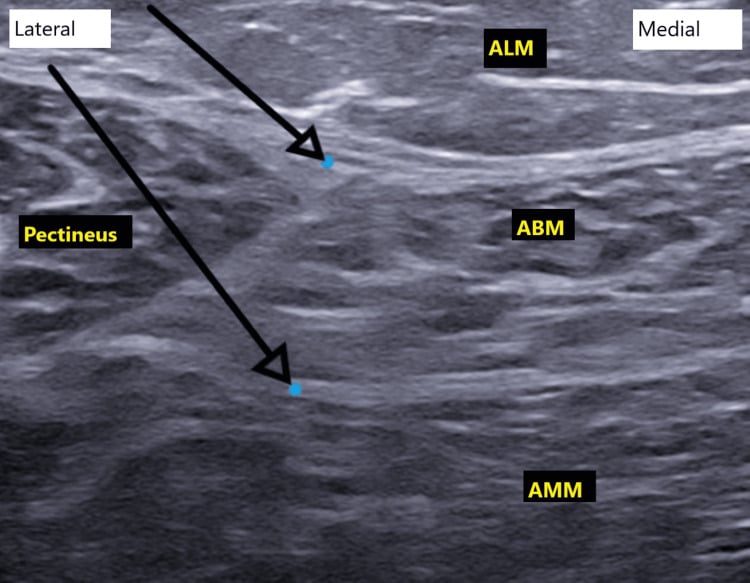 Transverse ultrasound showing the two target planes for anterior and posterior obturator branch blockade among pectineus, adductor longus, brevis and magnus.