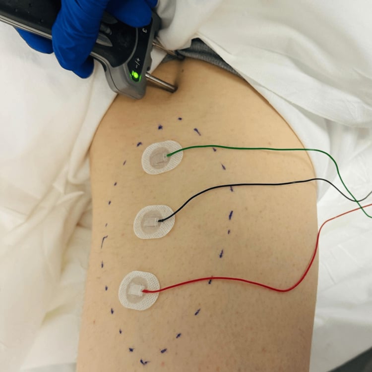Clinical setup for obturator motor conduction testing with stimulation below and lateral to the pubic tubercle and surface electrodes over the medial thigh.