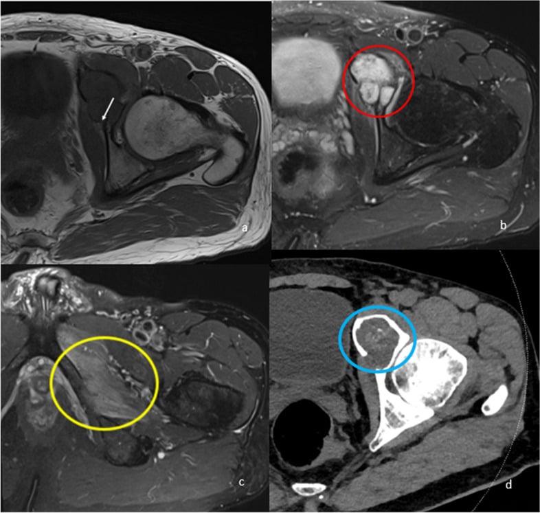 Axial T1 and fat-suppressed MRI with CT correlation showing a superior pubic ramus chondrosarcoma extending into the obturator canal and encroaching on the obturator nerve.