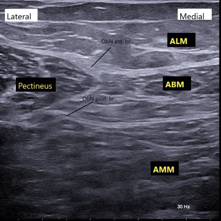 Transverse medial-thigh ultrasound identifies the anterior obturator branch between adductor longus and adductor brevis, and the posterior branch between adductor brevis and adductor magnus.