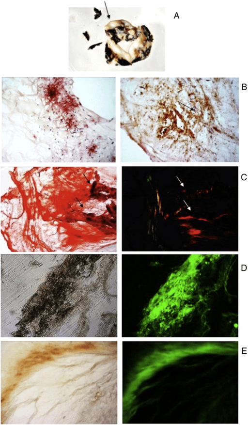 Multi-panel figure of an excised aortic valve in alkaptonuria with dark ochronotic pigment and accompanying histology